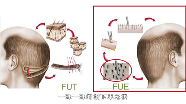 脱发的原因及解决办法---男性篇