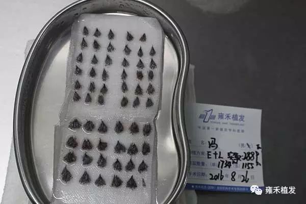 昆明植发2889单位6个月短发亮出帅