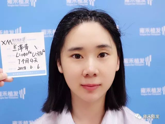 厦门雍禾小美女发际线种植效果