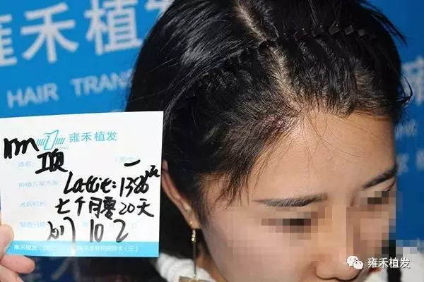 女士发际线种植1386单位居然就拯救了