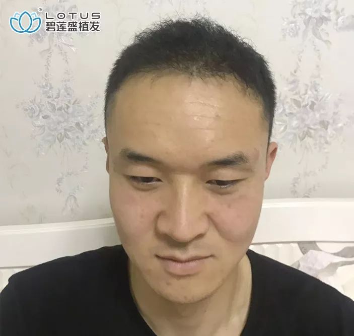 老司机扮小白来植发有什么鬼？