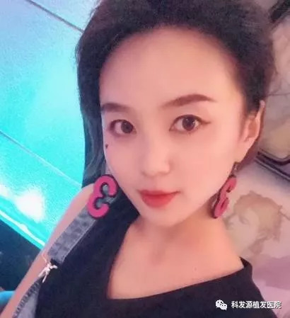 美女发际线种植遇见歌手巴藜发际线新LOOK