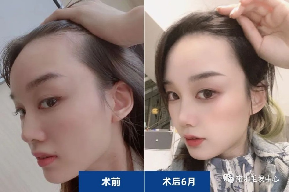 美女头发大额角，无锡雍禾发际线植发后不一样的美