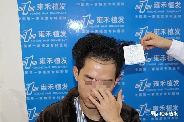 不理发植发！2250单位给发际镶个金边！形象金光闪闪