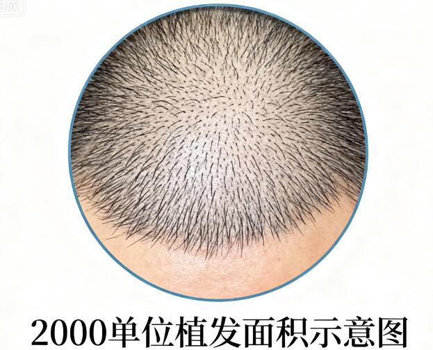 植发2000单位价格大起底:从“白菜价”到“天价”的真相揭秘