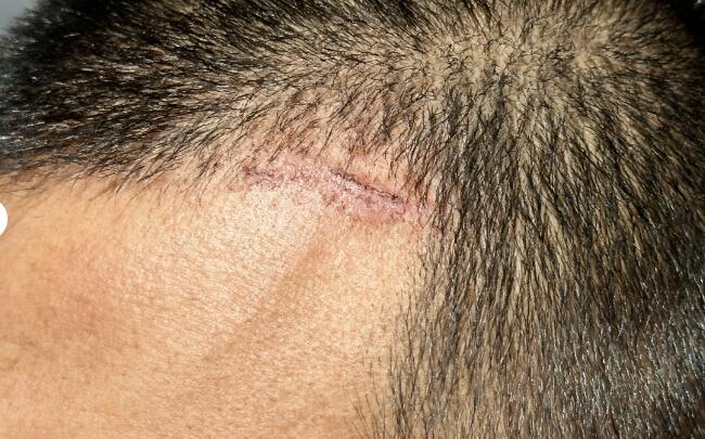 烧伤疤痕分次植发:成活率提升 30% 的黄金方案与 2025 年价格全解析