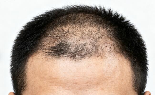 植发后会不会再次脱落？原生发还会掉吗？2026年权威解析