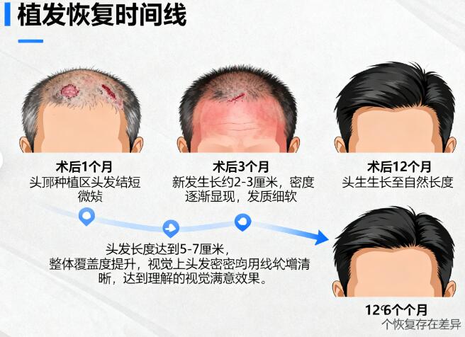 植发后多久能“自然到隐形”?技术选择决定效果持久度!2026年最新指南