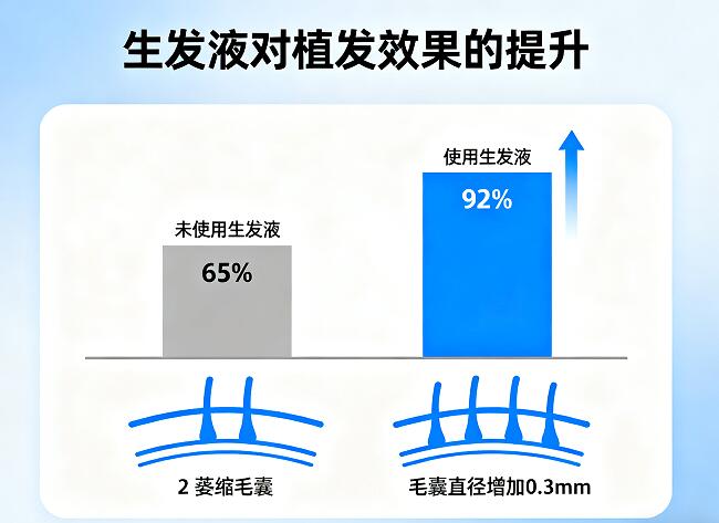 植发后外用生发液:提升效果密度的“秘密武器”,科学使用周期全解析