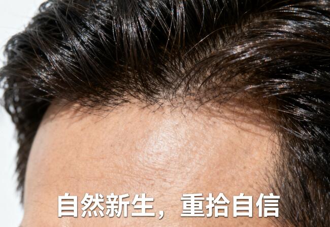 高端植发技术效果一定更好吗?性价比如何评估?