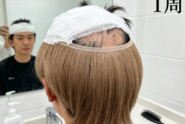 植发后多久能戴假发过渡？材质这样选不伤毛囊！
