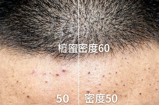 植发密度60与50深度对比:密度选择如何影响术后效果与自然度?
