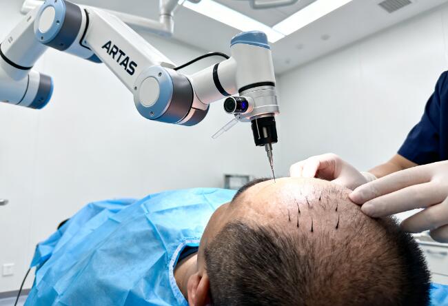 ARTAS机器人植发:大面积脱发患者的“高效救星”