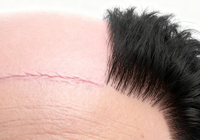 3D毛囊活化技术:疤痕脱发修复的革命性突破