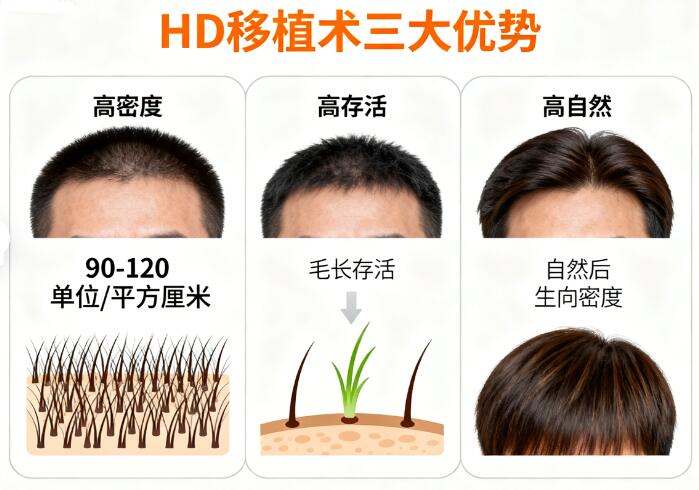 头顶加密HD高密度移植术效果:自然浓密的终极解决方案