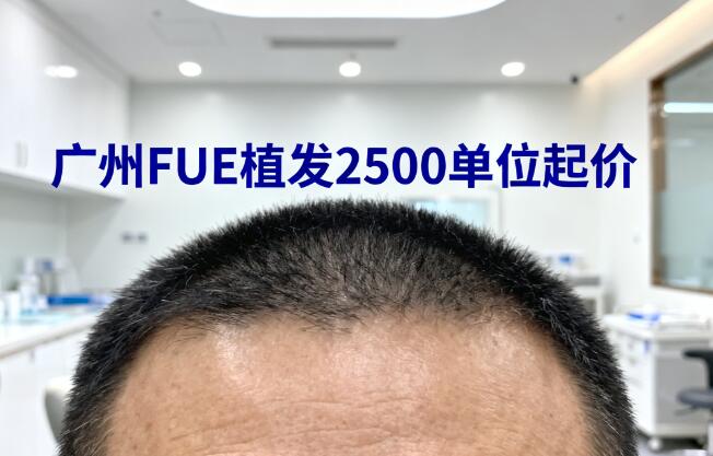广州FUE植发2500单位起价解析:技术、机构与性价比全攻略