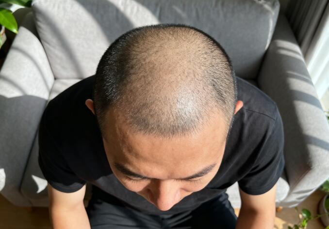 不剃发植发尴尬期7-15天护理全指南：4招化解尴尬，加速恢复自然