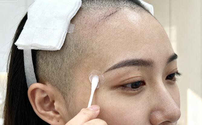 植发后3天结痂脱落正确方法：3步科学处理，避免毛囊损伤
