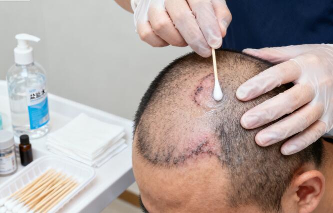 植发后3天结痂脱落？科学护理指南：温和清洁+专业养护是关键！