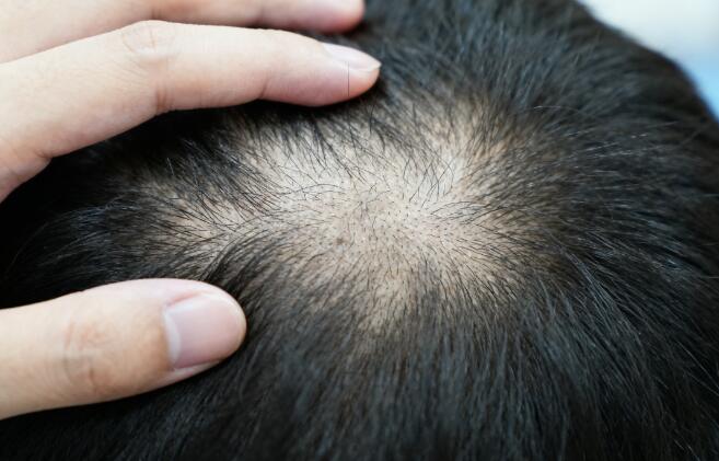 植发6个月密度不足?科学补救方案助你重获浓密秀发