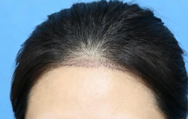 女性发缝加密微针植发效果全解析:自然浓密+高存活率的秘密