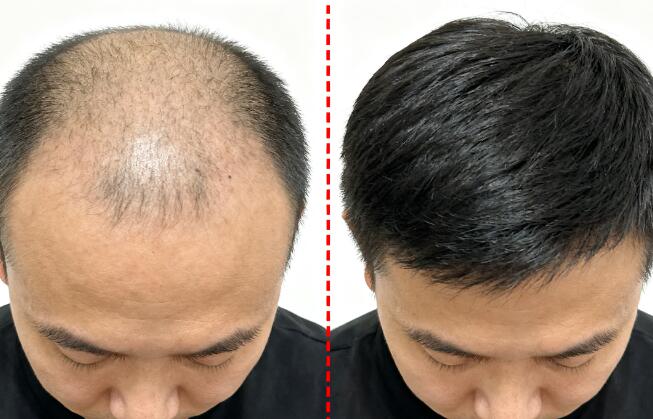 M型秃合并秃顶植发组合技术：双区域协同，重塑浓密发量