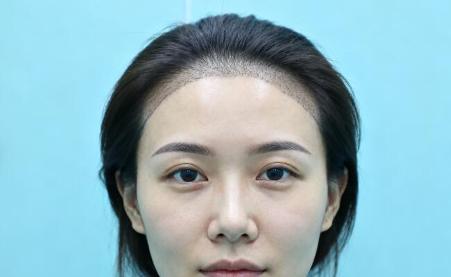 发际线生硬二次重塑方案:告别“假发感”,重塑自然美