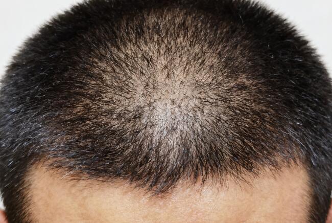 植发后头发粗细不均？这样改善让你“发”现惊喜！