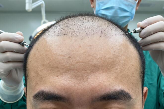 发际线过高？这些真实植发案例让你重燃希望！