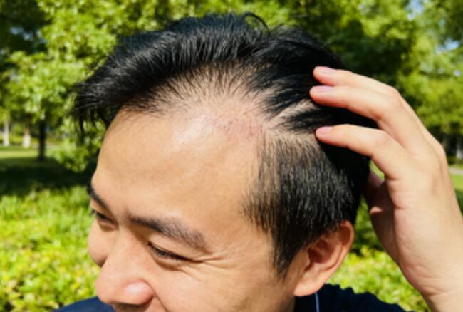 DHI植发技术:术后恢复周期全解析,让你告别漫长等待