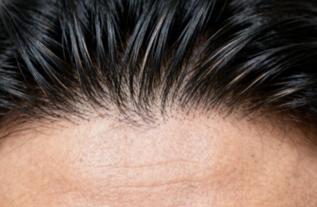 艺术发际线植发：毛流角度设计是“妈生感”的灵魂密码