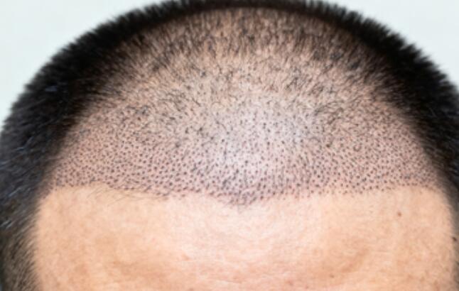 超精细不剃发植发单次提取量：为何2000单位是黄金上限？