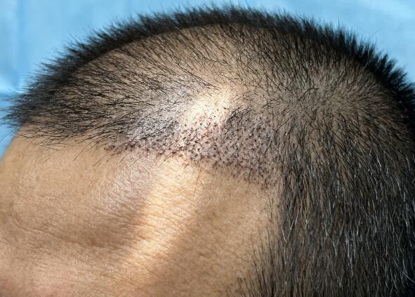 植发后6个月密度不足?科学补救方案让你重获浓密秀发!