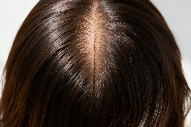 女性发缝加密微针植发效果：告别“通天河”，重塑蓬松少女感