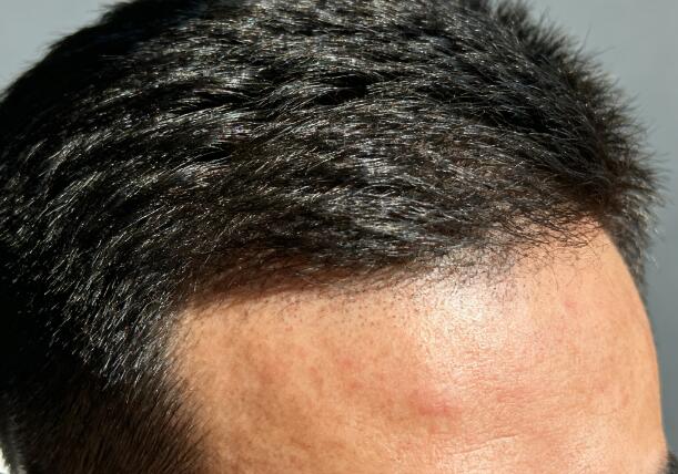 植发后9-12个月：解锁自然浓密发量的黄金蜕变期