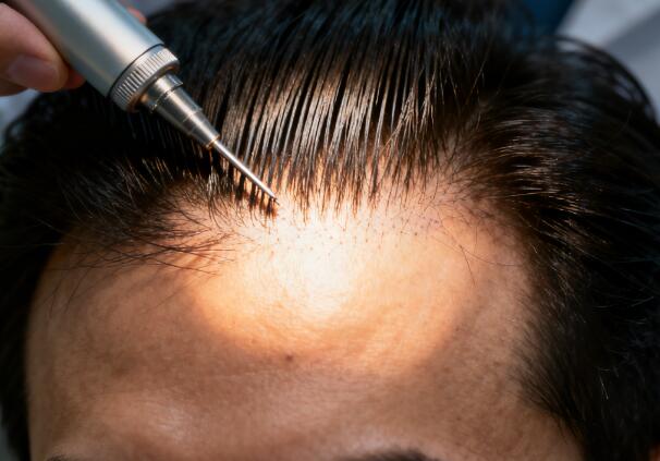 植发后毛流“乱跑”？精准调整方案让发丝“归位”自然