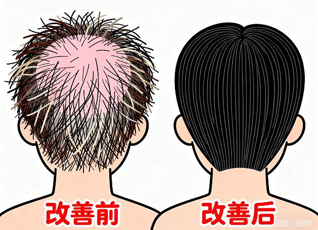 植发后头发粗细不均?这样改善才真靠谱