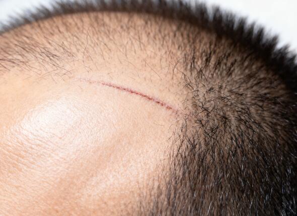 激光“开路”疤痕，植发“接力”重生：这组合拳太猛了！