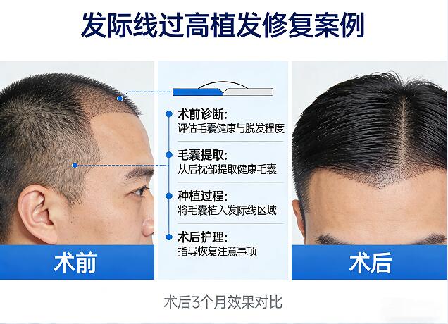 植发后头发干枯毛躁?养护秘籍让你重获柔顺秀发!