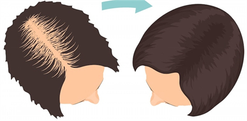 【2026植发价格表一览表】3大技术对比指南:从2.4万到19.5万,你的秃头预算该选哪一档?