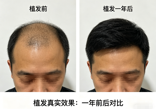 植发真实效果怎么样?一年前后的对比图告诉你答案