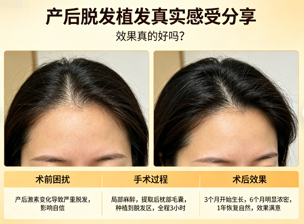 产后脱发植发真实感受分享，效果真的好吗？