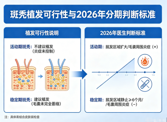 斑秃可以植发吗？2026年医生对活动期与稳定期的判断标准