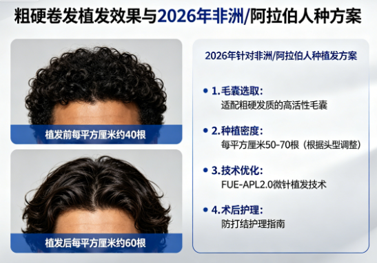 粗硬卷发植发会显得更密吗?2026年针对非洲/阿拉伯人种方案