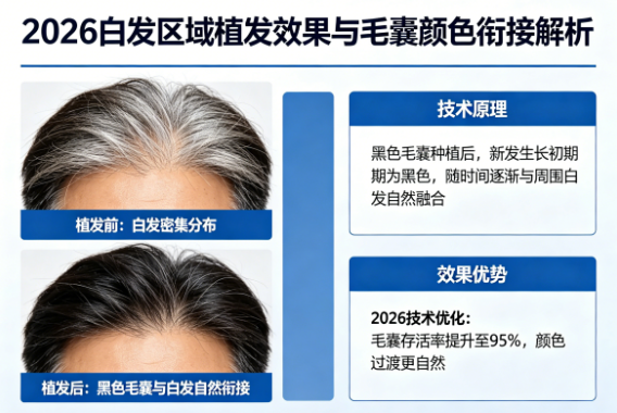 白发区域植发效果如何?黑色毛囊与白发的颜色衔接问题2026