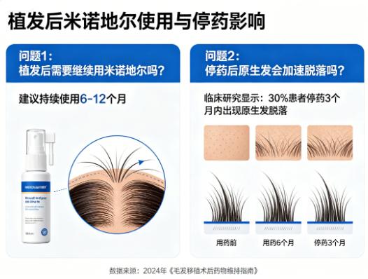 植发后需要继续用米诺地尔吗?停药后原生发加速脱落的证据